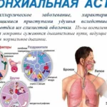 Лечение бронхиальной астмы. Терапия. (3)