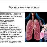 Лечение бронхиальной астмы. Терапия.(1)