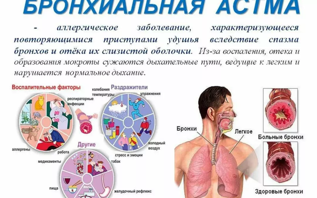 Лечение бронхиальной астмы. Терапия. (3)