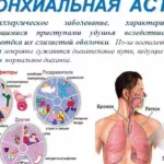 Лечение бронхиальной астмы. Терапия. (3)